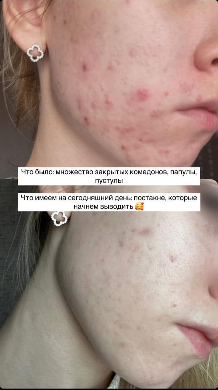 Уход за кожей лица для девочек-подростков: советы косметолога 6 whatsapp image 2025 04 13 at 18.55.06 1
